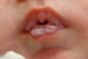 грибковые заболевание детей - кандидоз